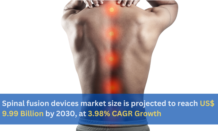 Spinal fusion devices market size is projected to reach US$ 9.99 Billion by 2030